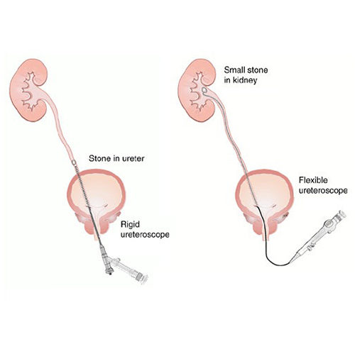 Ureteroscopy rigid vs flexiu